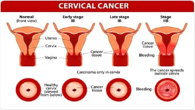 cervical cancer