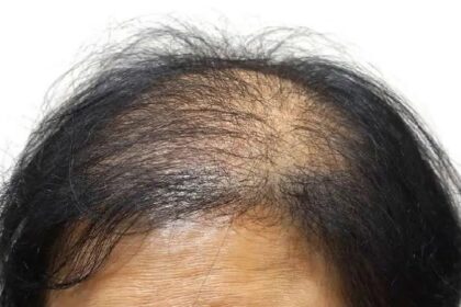 Baldness Remedy: गंजेपन से पाना है छुटकारा, तो इस्तेमाल करें यह प्राकृतिक उपाय