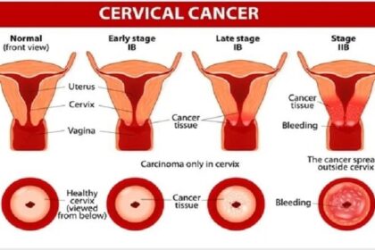 Cervical Cancer: जाने क्या होता है सर्वाइकल कैंसर; जाने इसके कारण, लक्षण और बचाव के बारे में