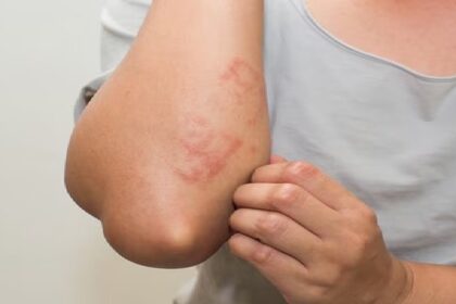 Itching After Waxing: वैक्सिंग के बाद खुजली, दाने व रैशेज को कैसे करें दूर? पढ़े